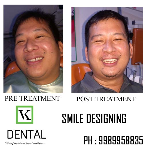 SMILE DESIGNING